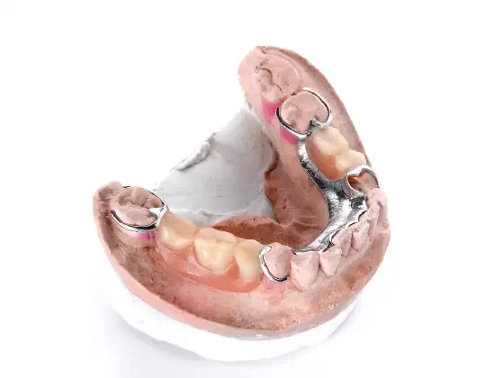 Cast Metal Partial Dentures: Pros, Cons and Cost