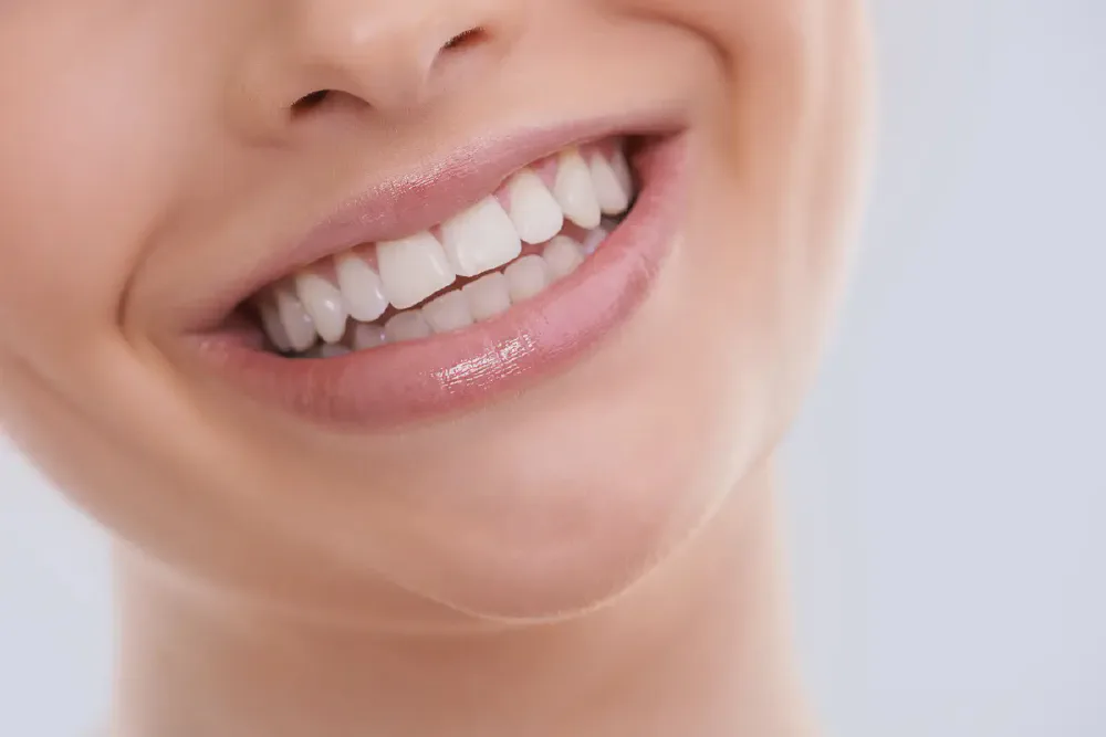 Dental Veneer Aftercare Tips: Keep Your Smile Beautiful
