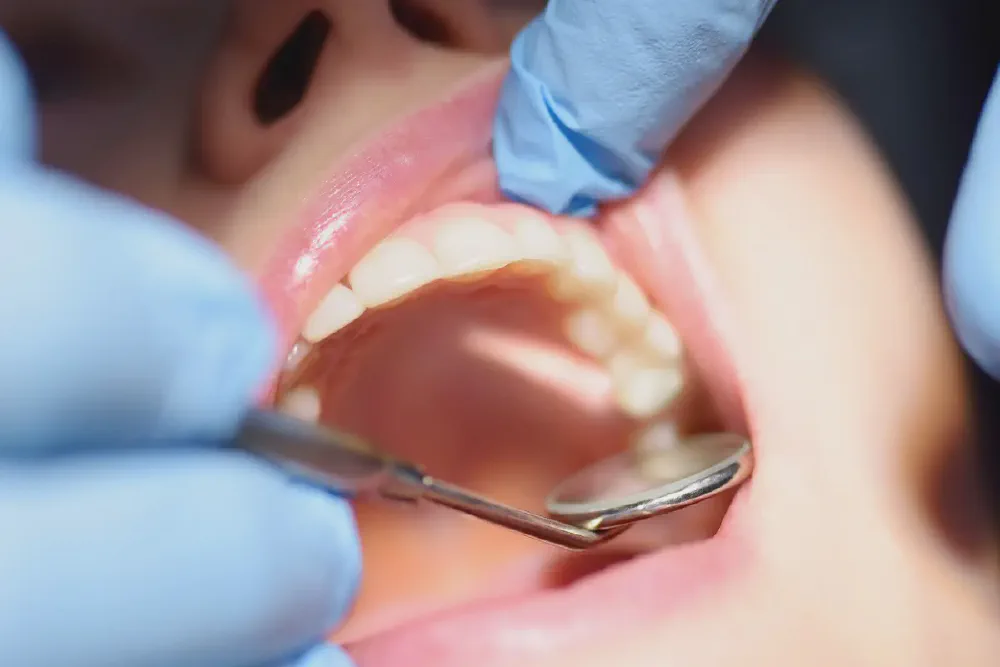 Dry Socket: Symptoms, Causes and Relief