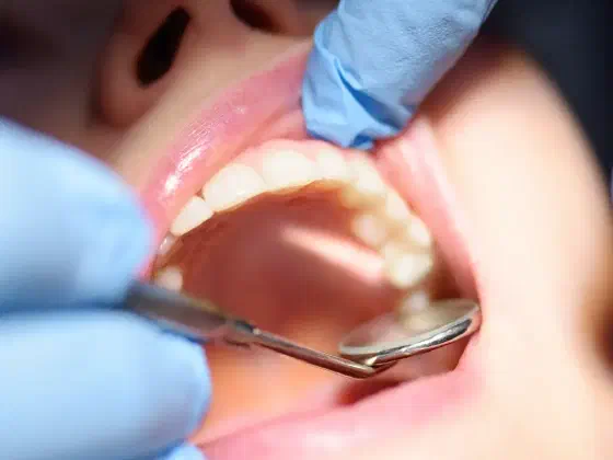 Dry Socket: Symptoms, Causes and Relief