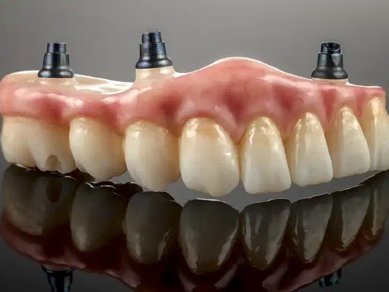 Implant-Supported Dentures: Your Key to a Confident Smile