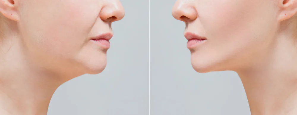 Mewing Explained: A Natural Way to Define Your Jawline