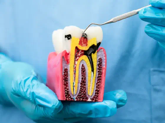 Dental Plaque and Biofilm: What They Are, How to Remove Them