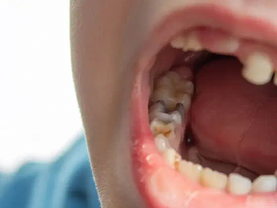 Rotten Teeth: Causes, Treatment and Prevention
