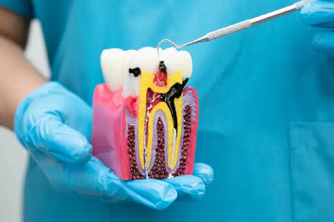 decayed tooth model
