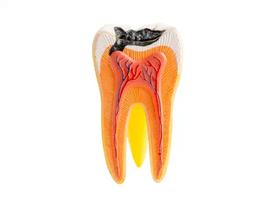 Tooth Decay and Cavities: Stages, Symptoms, Treatment