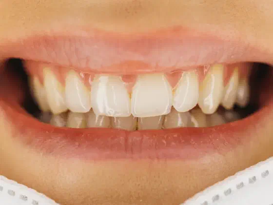 Why Teeth Aren’t Bones & Why It Matters for Tooth Decay