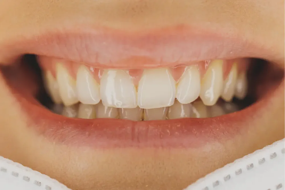 Why Teeth Aren’t Bones & Why It Matters for Tooth Decay
