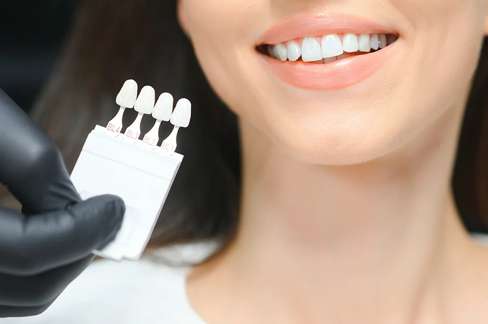Levels of Shades for Teeth Whitening