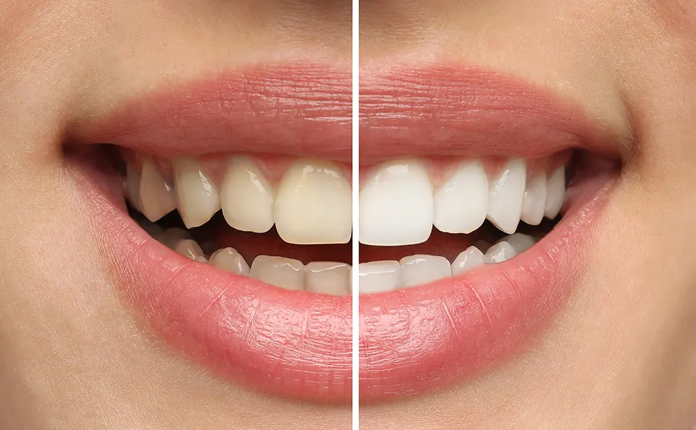 Closeup of before and after teeth whitening at our dental clinic