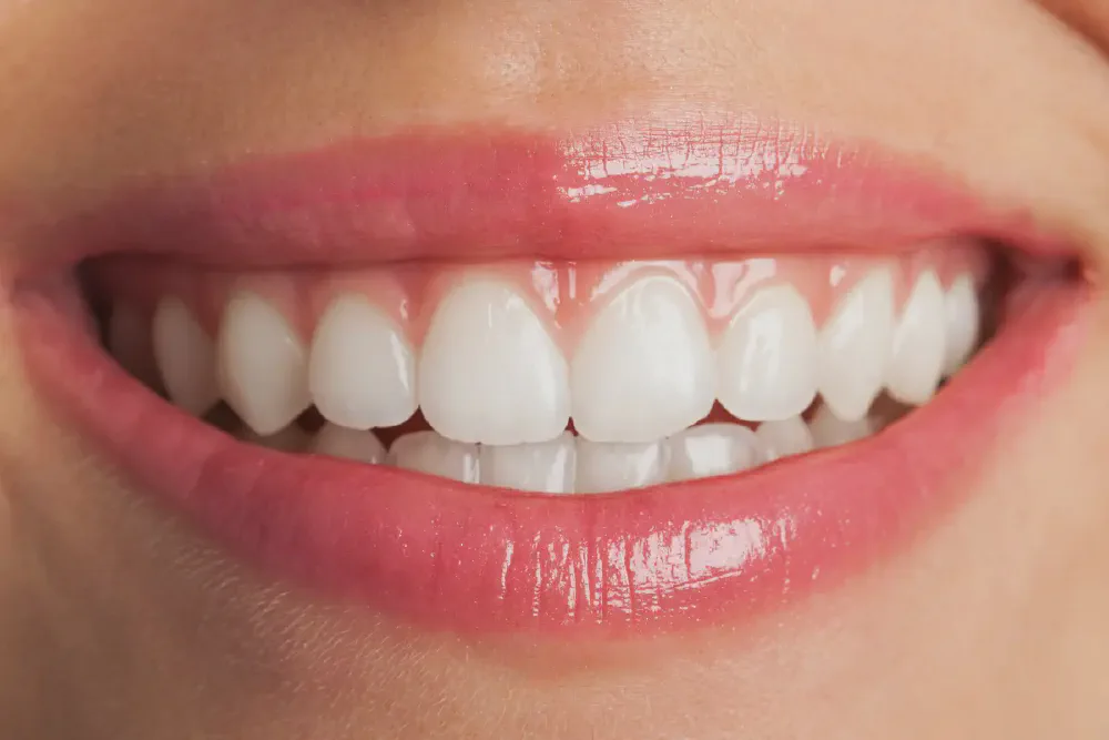 Porcelain Veneers in Rancho Cucamonga