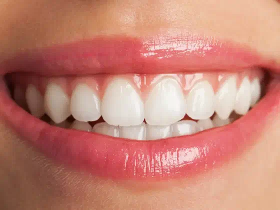 Veneers in Rancho Cucamonga