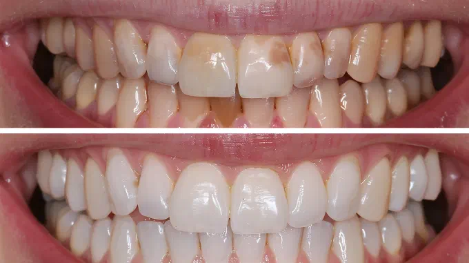 Veneers before and after