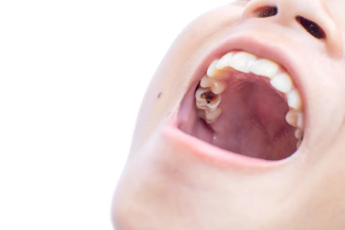 teeth with cavities