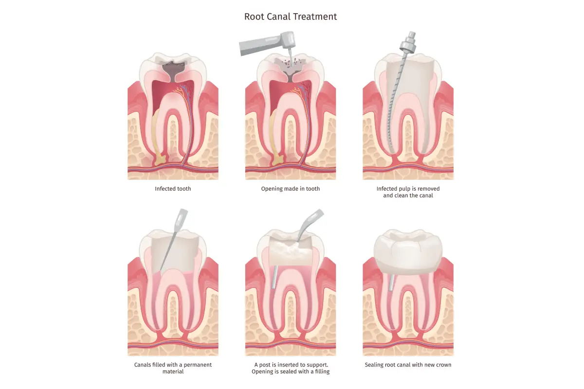 Illustration on root canal treatment