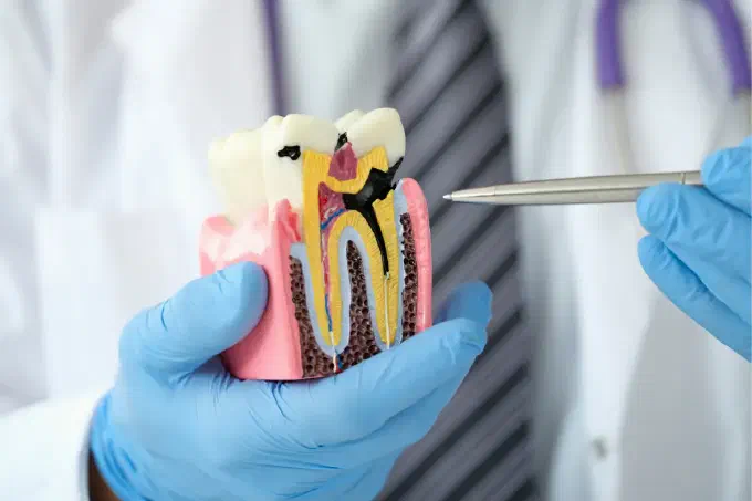 Root canal illustration