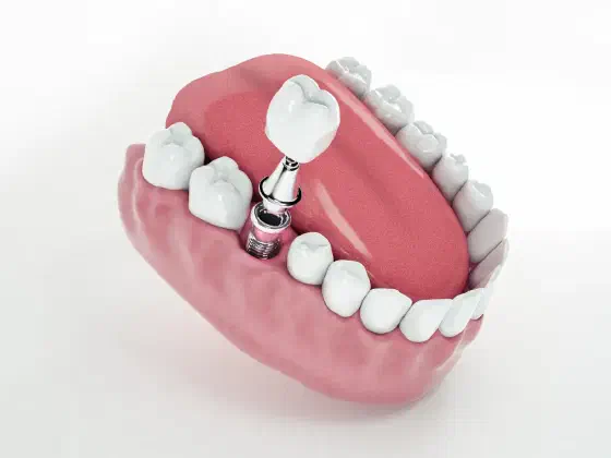Dental Implant Recovery: Step-by-Step Post-Op Guide