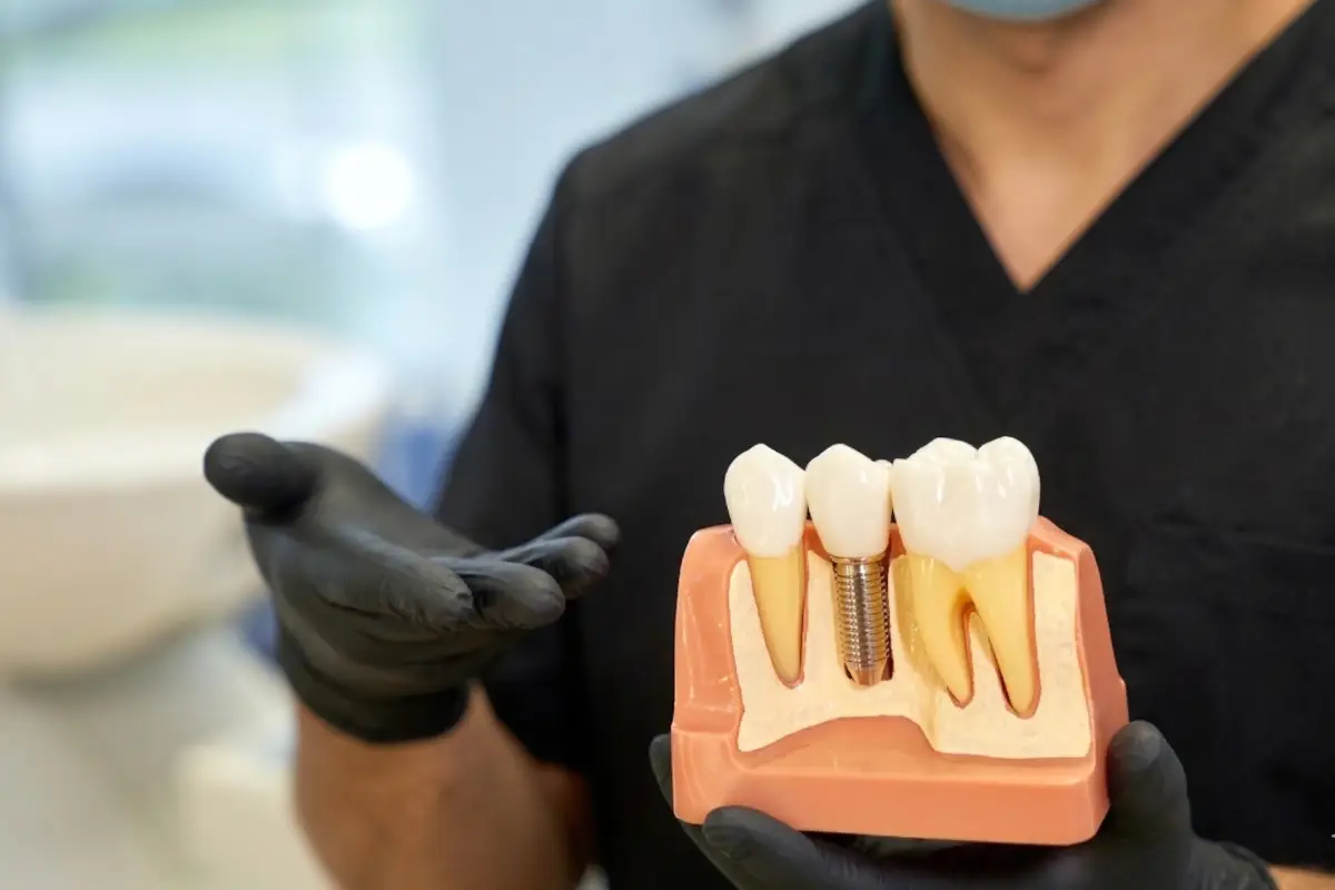dental implant model