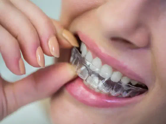 How to Clean Clear Aligners: Easy & Effective Tips
