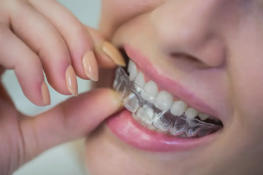 How to Clean Clear Aligners: Easy & Effective Tips