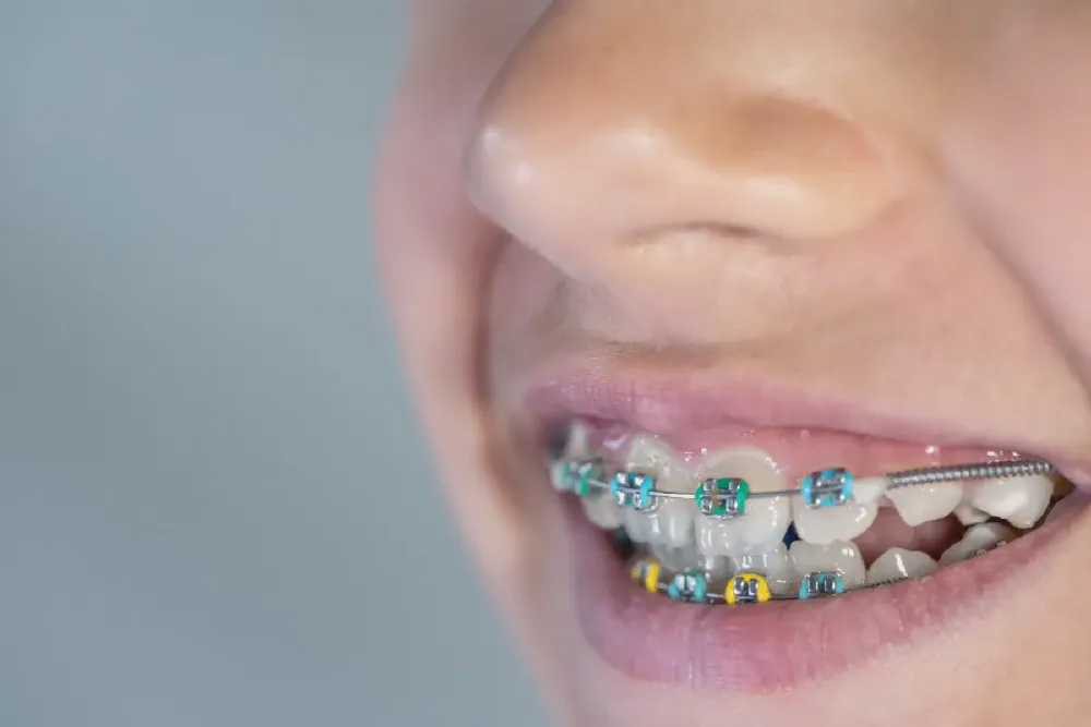 Straighten Your Smile with Orthodontic Care