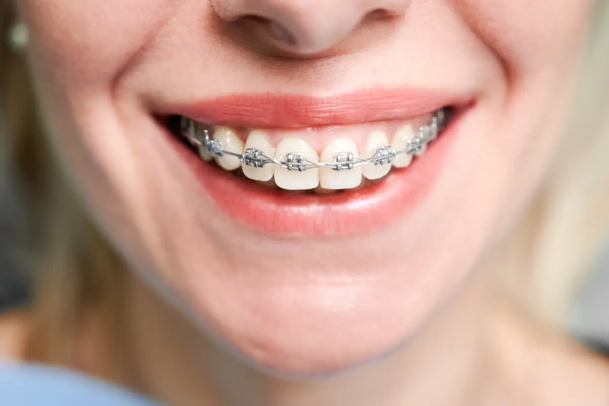 Image of a tradional braces
