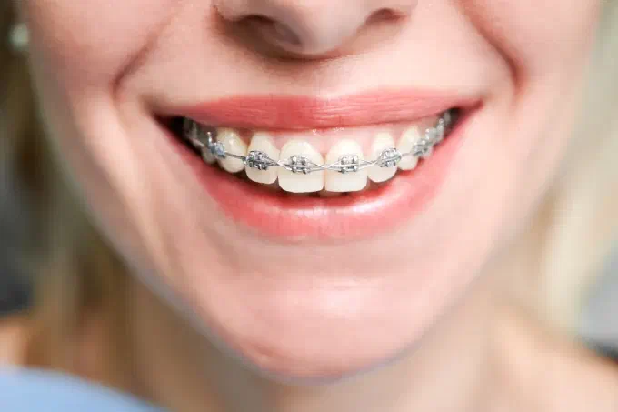 Image of a tradional braces