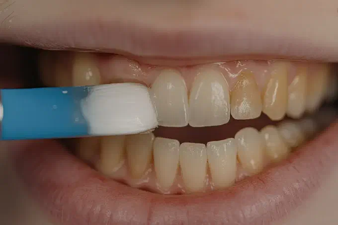 Fluoride varnish application
