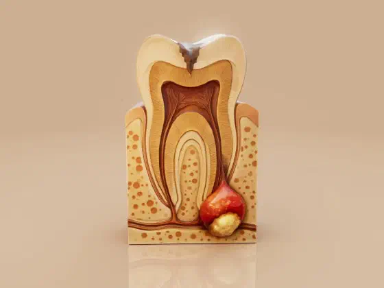 What to Expect from Root Canal Treatment
