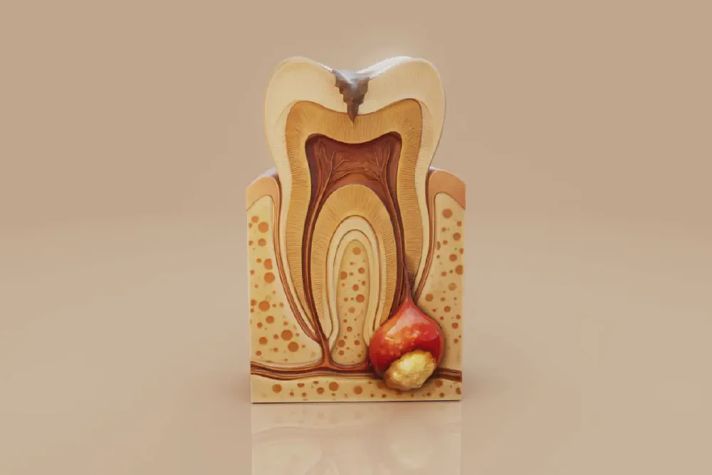 What to Expect from Root Canal Treatment