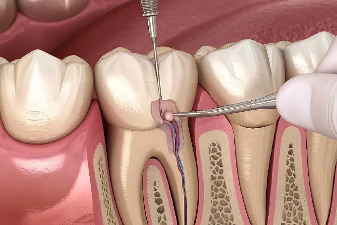 Illustration Root Canal Treatment