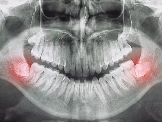 Wisdom Teeth Recovery: Heal Faster After Extraction