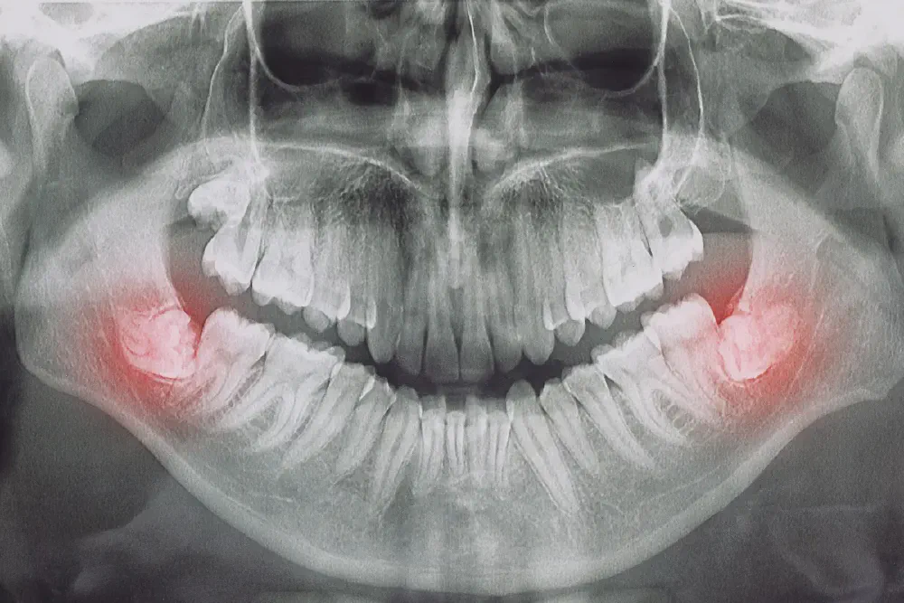 Wisdom Teeth Recovery: Heal Faster After Extraction