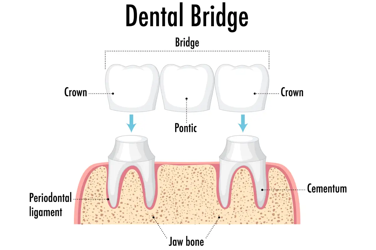 dental bridges illustration