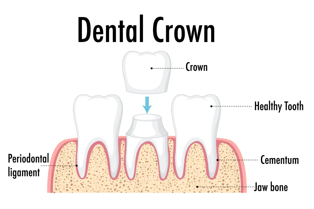 dental crown illustration