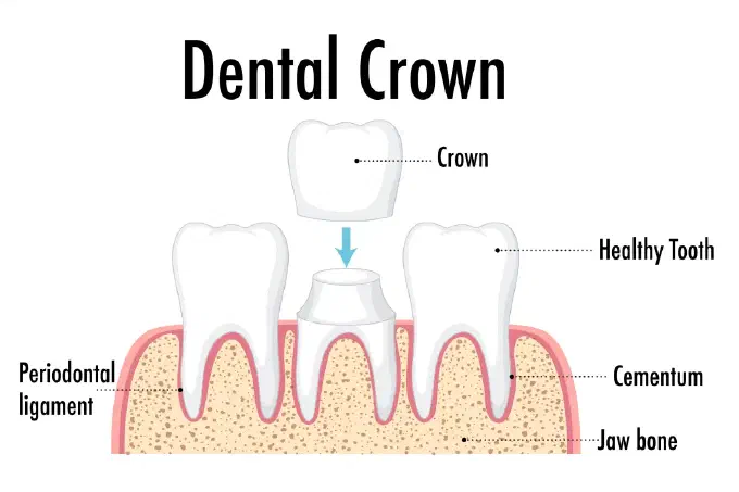 dental crown illustration