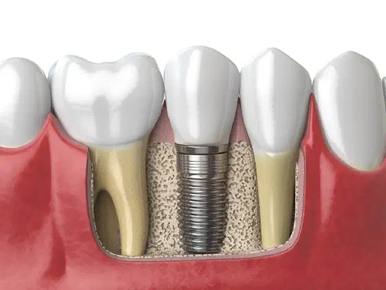Cross-section of a dental implant: a post in the jawbone topped with a crown
